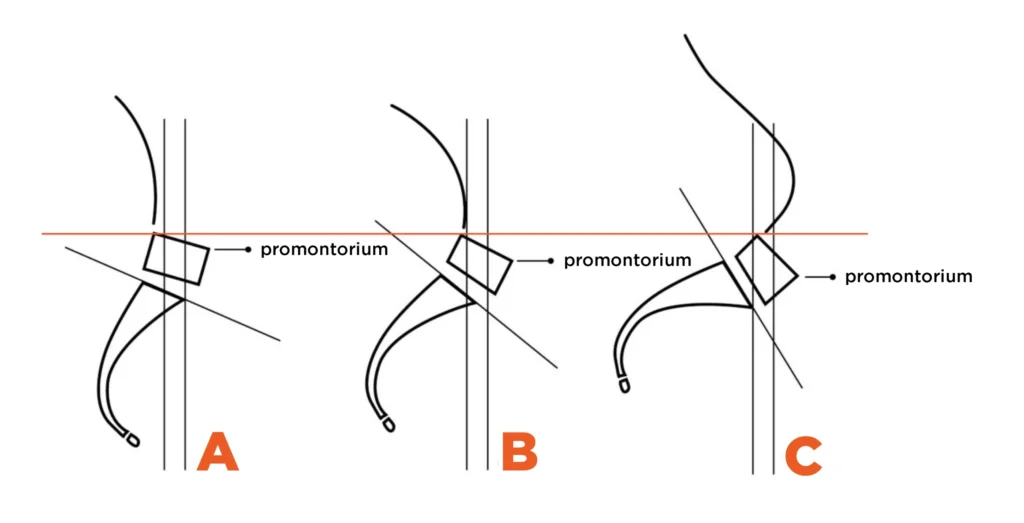 Typy budowy miednicy według Gutmanna