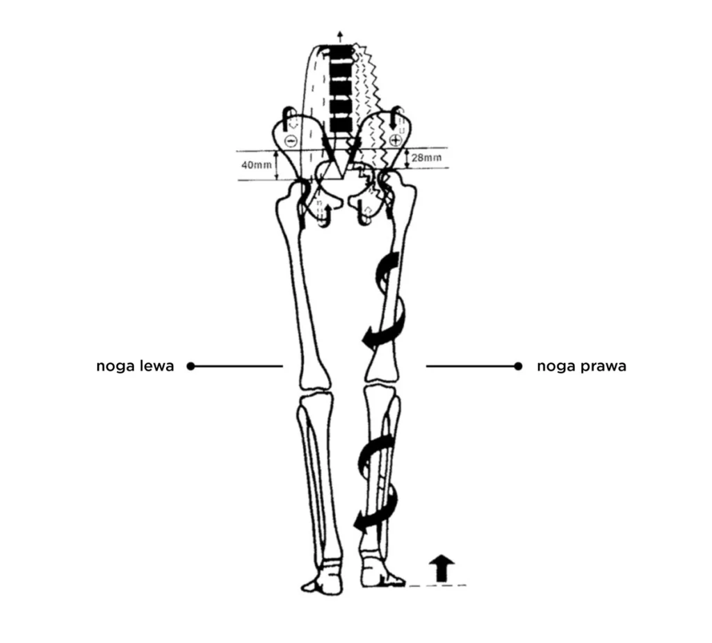 Schemat ukazujący zjawisko dystorsji miednicy