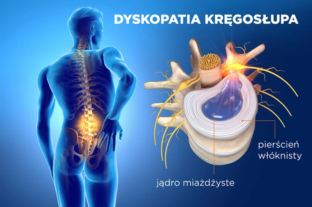 Przekrój kręgosłupa pokazujący zjawisko dyskopatii